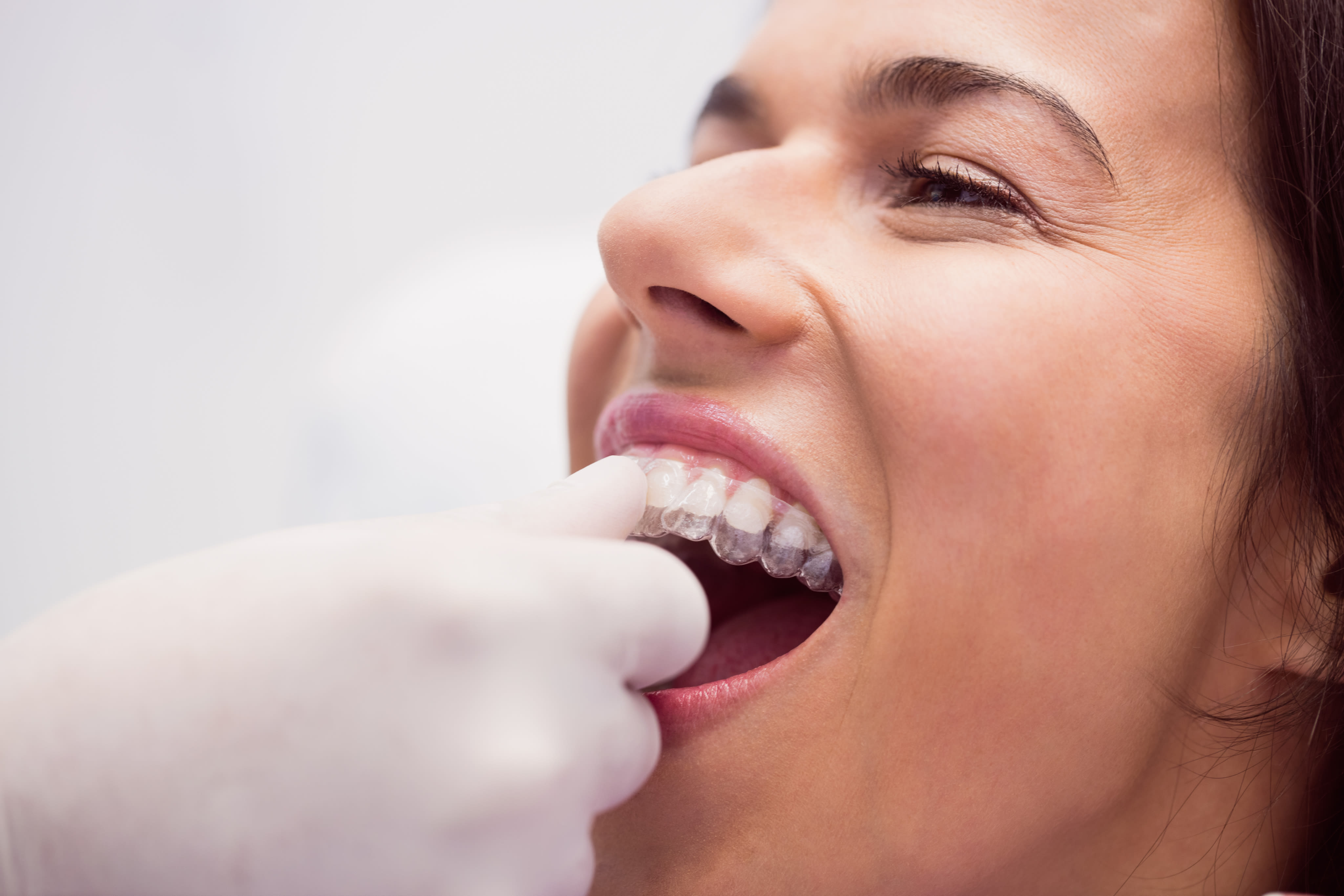 Patient comfortably inserting a clear aligner
